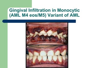 Gingival Infiltration in Monocytic
(AML M4 eos/M5) Variant of AML
 