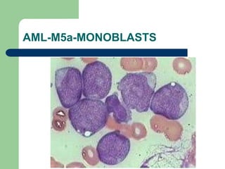 AML-M5a-MONOBLASTS
 