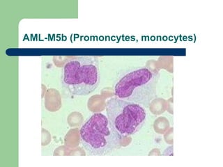 AML-M5b (Promoncytes, monocytes)
 