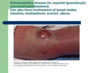 Extramedullary disease (ie, myeloid /granulocytic
sarcoma/myeloblastoma)
Can also have involvement of lymph nodes,
intestine, mediastinum, ovaries, uterus
 