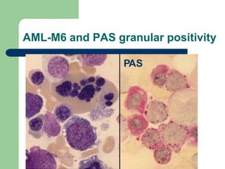 AML-M6 and PAS granular positivity
PAS
 