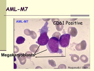 AML-M7
AML-M7
Megakaryoblasts
CD61 Positive
 