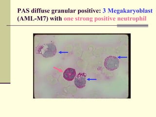 PAS diffuse granular positive: 3 Megakaryoblast
(AML-M7) with one strong positive neutrophil
 