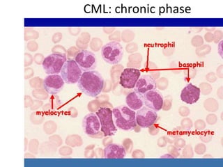 CML: chronic phase
 
