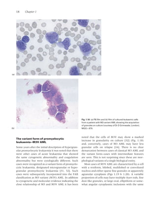 Promyelo Leukaemia Diagnosis ( PDFDrive ).pdf