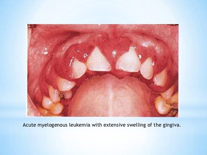 Leukaemia in periodontology