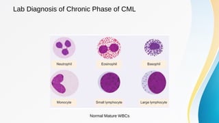 Cml Normal Leukaemia lecture 03: Chronic Myeloid Leukaemia | PDF