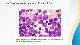 Leukaemia lecture 03: Chronic Myeloid Leukaemia | PDF