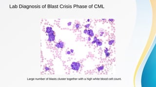 Leukaemia lecture 03: Chronic Myeloid Leukaemia | PDF