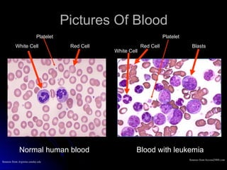 Leukemia Types Overview Comprehensive Overview of Leukemias: Types, Diagnosis, and Treatment | PPT