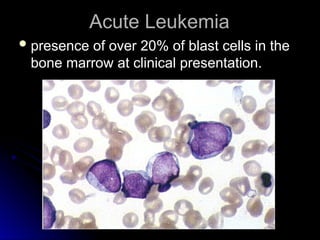 Leukemia Types Overview Comprehensive Overview of Leukemias: Types, Diagnosis, and Treatment | PPT