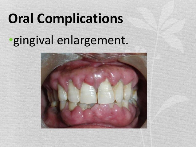 View of Leukemia and oral manifestations