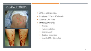 LEUKEMIA.pptx