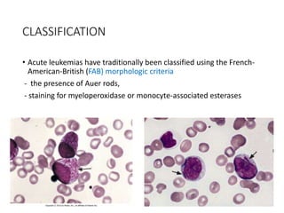CLASSIFICATION
• Acute leukemias have traditionally been classified using the French-
American-British (FAB) morphologic criteria
- the presence of Auer rods,
- staining for myeloperoxidase or monocyte-associated esterases
 