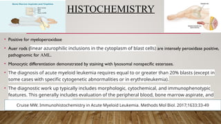 HISTOCHEMISTRY
• Positive for myeloperoxidase
• Auer rods (linear azurophilic inclusions in the cytoplasm of blast cells) are intensely peroxidase positive,
pathognomic for AML.
• Monocytic differentiation demonstrated by staining with lysosomal nonspecific esterases.
• The diagnosis of acute myeloid leukemia requires equal to or greater than 20% blasts (except in
some cases with specific cytogenetic abnormalities or in erythroleukemia).
• The diagnostic work up typically includes morphologic, cytochemical, and immunophenotypic
features. This generally includes evaluation of the peripheral blood, bone marrow aspirate, and
bone marrow trephine biopsy
Cruise MW. Immunohistochemistry in Acute Myeloid Leukemia. Methods Mol Biol. 2017;1633:33-49
 