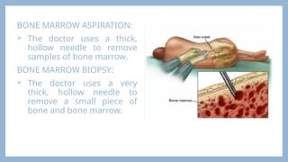BONE MARROW ASPIRATION:
 The doctor uses a thick,
hollow needle to remove
samples of bone marrow.
BONE MARROW BIOPSY:
 The doctor uses a very
thick, hollow needle to
remove a small piece of
bone and bone marrow.
 
