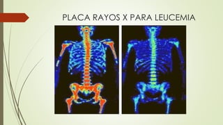 PLACA RAYOS X PARA LEUCEMIA
 