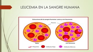 LEUCEMIA EN LA SANGRE HUMANA
 