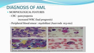 DIAGNOSIS OF AML
 MORPHOLOGICAL FEATURES
- CBC : pancytopenia
increased WBC (bad prognosis)
- Peripheral blood smear : myeloblast (Auerrods m3>m2)
 