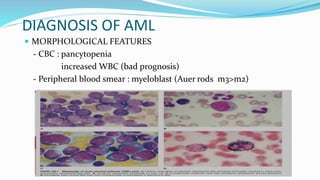 DIAGNOSIS OF AML
 MORPHOLOGICAL FEATURES
- CBC : pancytopenia
increased WBC (bad prognosis)
- Peripheral blood smear : myeloblast (Auer rods m3>m2)
 