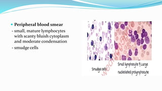  Peripheral blood smear
- small, mature lymphocytes
with scanty bluish cytoplasm
and moderate condensation
- smudge cells
 