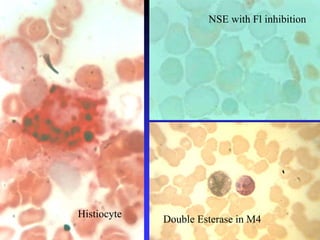 Double Esterase in M4
NSE with Fl inhibition
Histiocyte
 