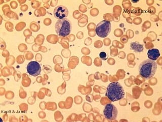 Myelofibrosis
 