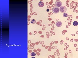 Myelofibrosis
 