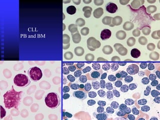 CLL
PB and BM
 