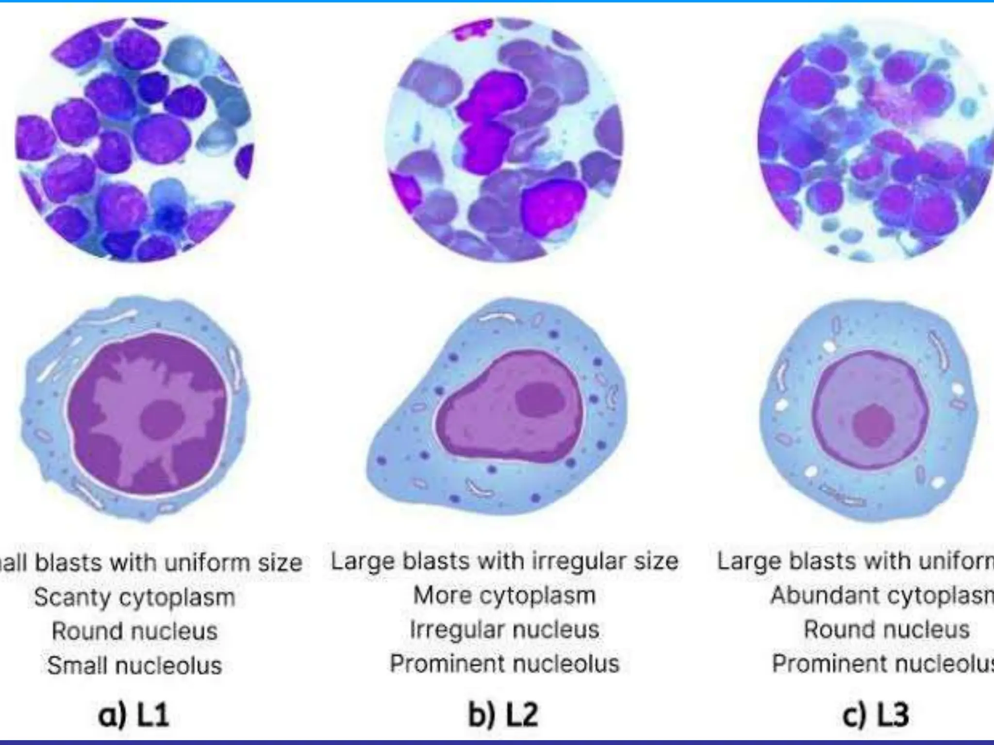 Leukemia Acute Lymphoblastic Leukemia Pediatrics final .pptx