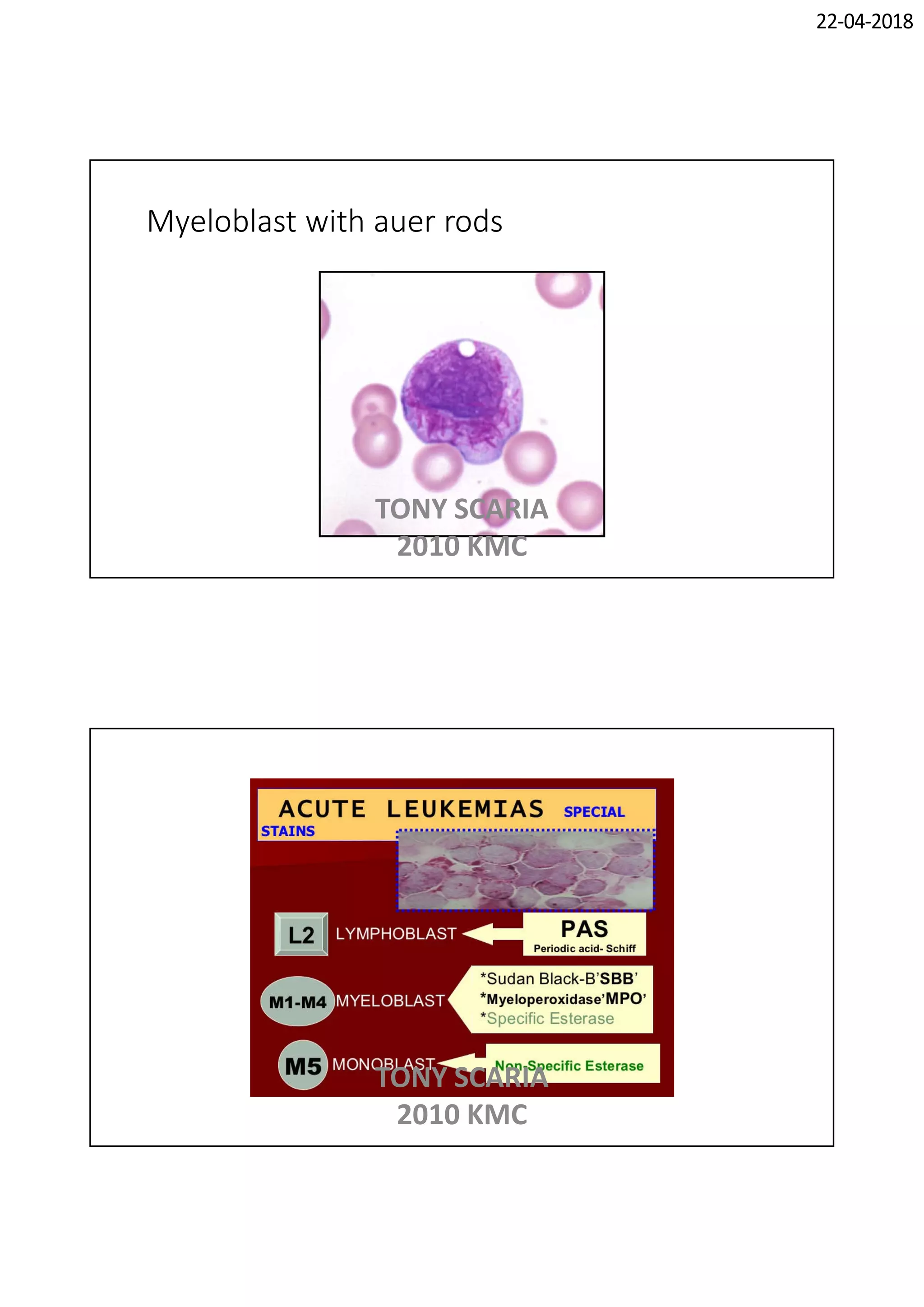 Leukemia and lymphoma PATHOLOGY REVISION NOTES | PDF