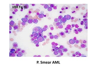 P. Smear AML
 