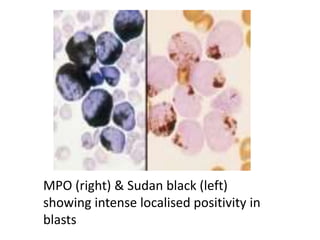 MPO (right) & Sudan black (left)
showing intense localised positivity in
blasts
 