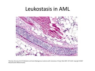 Leukostasis in AML
Thornton, KA, Levis, M. FLT3 Mutation and Acute Myelogenous Leukemia with Leukostasis. N Engl J Med 2007; 357:1639. Copyright ©2007
Massachusetts Medical Society
 
