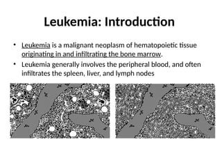 Leukemias. A integral part of hematology | PPTX