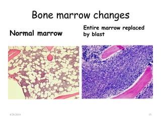 Bone marrow changes
Normal marrow
Entire marrow replaced
by blast
4/28/2014 15
 