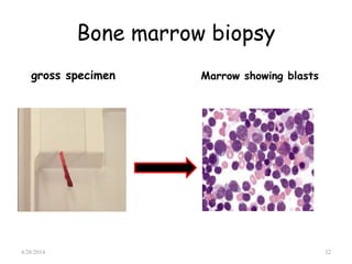 Bone marrow biopsy
gross specimen Marrow showing blasts
4/28/2014 32
 