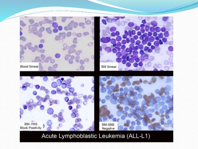 what is the rarest form of leukemia leukemia what is the rarest form of leukemia leukemia