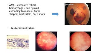 LEUKEMIC DISEASES AND THE EYE.pptx. This talks about the ocular ...