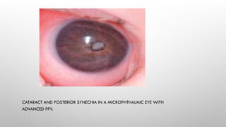 Microphthalmic Leukocoria copy.pptx Discriminating features of leukocoria | PPTX