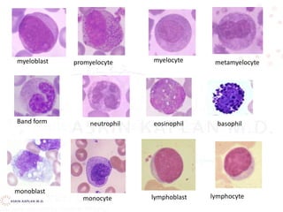 myeloblast
neutrophil
promyelocyte myelocyte
Band form
metamyelocyte
eosinophil basophil
monoblast
monocyte lymphoblast lymphocyte
 