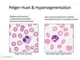Pelger-Huet & Hypersegmentation
Bilobed and occasional
unsegmented neutrophils
Autosomal recessive disorder
Rare autosomal dominant condition
Neutrophil function is essentially normal
Pelger-Huet anomaly Neutrophil hyper-segmentation
 