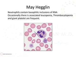 May Hegglin
Neutrophils contain basophilic inclusions of RNA
Occasionally there is associated leucopenia, Thrombocytopenia
and giant platelet are frequent.
 