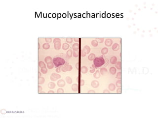 Mucopolysacharidoses
 