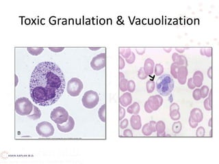 Toxic Granulation & Vacuolization
 