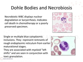Dohle Bodies and Necrobiosis
Necrobiotic WBC displays nuclear
degradation or karyorrhexis. Indicates
cell death in chemotherapy or a poorly
preserved specimen.
Single or multiple blue cytoplasmic
inclusions. They represent remnants of
rough endoplasmic reticulum from earlier
maturational stages.
They are associated with myeloid "left
shifts" and are seen in conjunction with
toxic granulation.
 