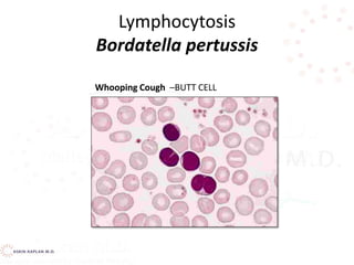 Lymphocytosis
Bordatella pertussis
Whooping Cough –BUTT CELL
 