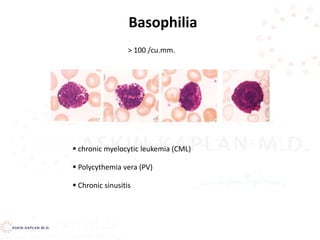  chronic myelocytic leukemia (CML)
 Polycythemia vera (PV)
 Chronic sinusitis
> 100 /cu.mm.
Basophilia
 