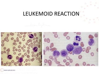 LEUKEMOID REACTION
 