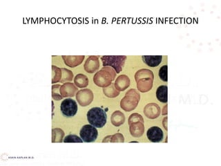 LYMPHOCYTOSIS in B. PERTUSSIS INFECTION
 